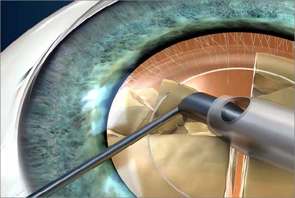 Phacoemulsification