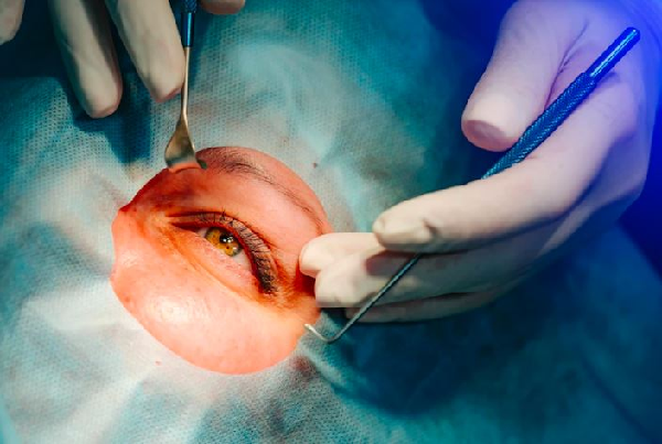 Lasik Surgery